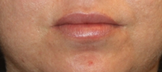 Injectable Fillers Before & After Patient #23274