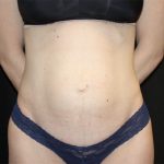 Tummy Tuck Before & After Patient #22380