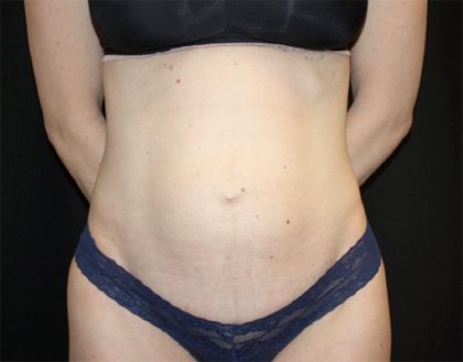 Tummy Tuck Before & After Patient #22380