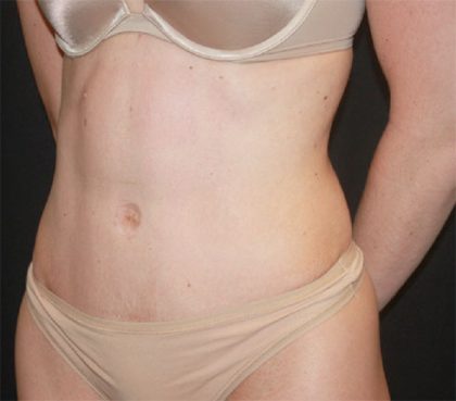 Tummy Tuck Before & After Patient #22380