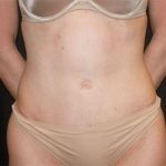 Tummy Tuck Before & After Patient #22380