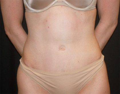 Tummy Tuck Before & After Patient #22380