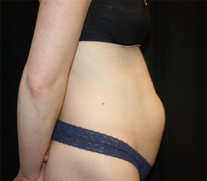 Tummy Tuck Before & After Patient #22380