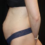 Tummy Tuck Before & After Patient #22380