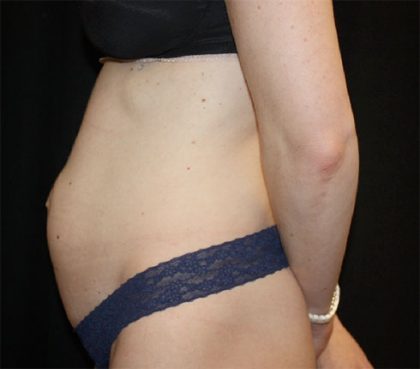 Tummy Tuck Before & After Patient #22380