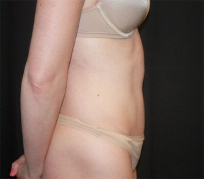 Tummy Tuck Before & After Patient #22380