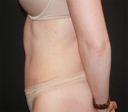 Tummy Tuck Before & After Patient #22380