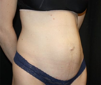 Tummy Tuck Before & After Patient #22380