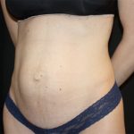 Tummy Tuck Before & After Patient #22380