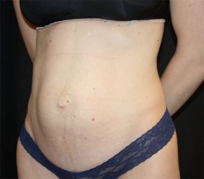 Tummy Tuck Before & After Patient #22380