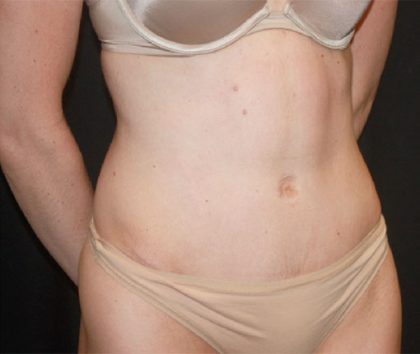 Tummy Tuck Before & After Patient #22380