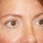 Blepharoplasty Before & After Patient #24924