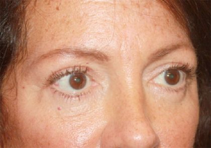 Blepharoplasty Before & After Patient #24924