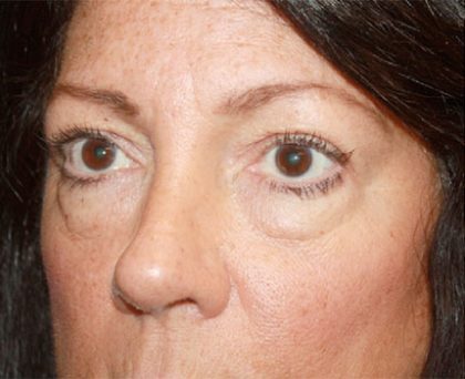 Blepharoplasty Before & After Patient #24924