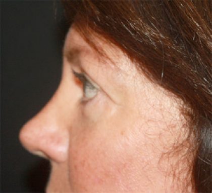 Blepharoplasty Before & After Patient #24924