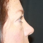 Blepharoplasty Before & After Patient #24924