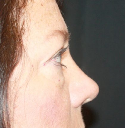 Blepharoplasty Before & After Patient #24924