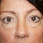 Blepharoplasty Before & After Patient #24924