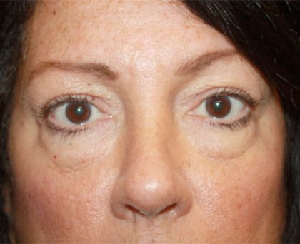 Blepharoplasty Before & After Patient #24924