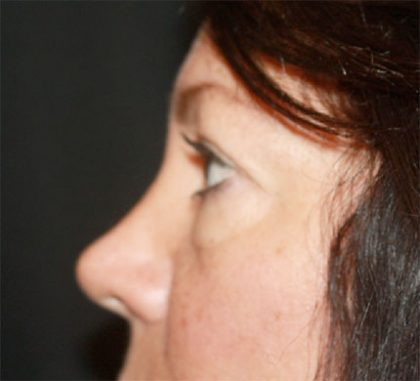 Blepharoplasty Before & After Patient #24924