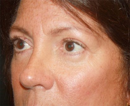 Blepharoplasty Before & After Patient #24924