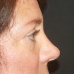 Blepharoplasty Before & After Patient #24924