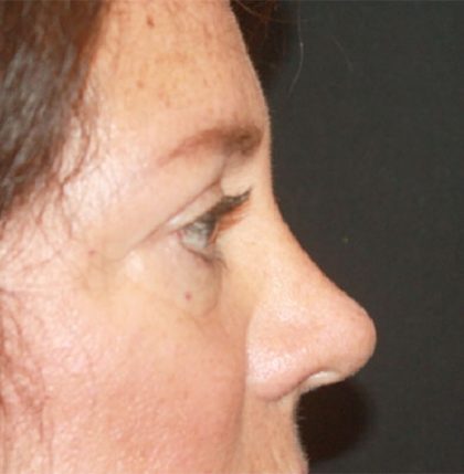 Blepharoplasty Before & After Patient #24924