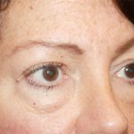 Blepharoplasty Before & After Patient #24924
