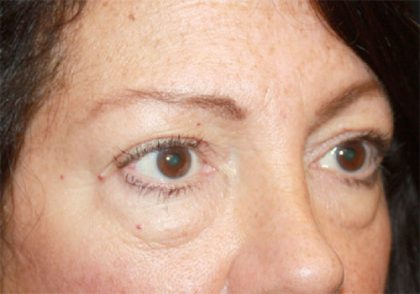 Blepharoplasty Before & After Patient #24924