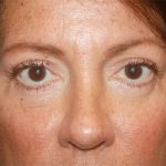 Blepharoplasty Before & After Patient #24924