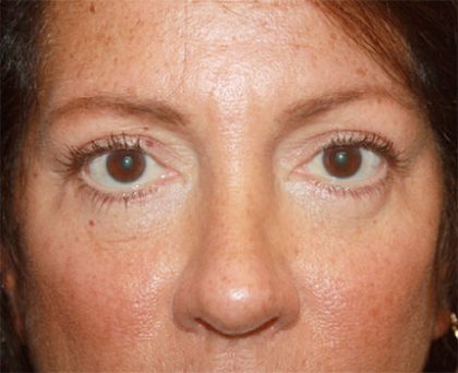 Blepharoplasty Before & After Patient #24924