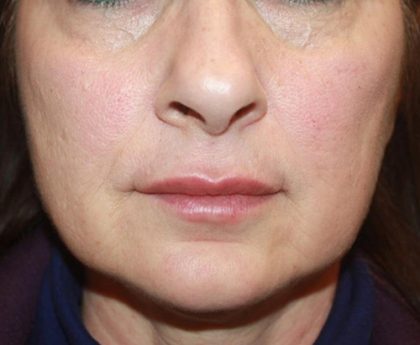 Injectable Fillers Before & After Patient #23267