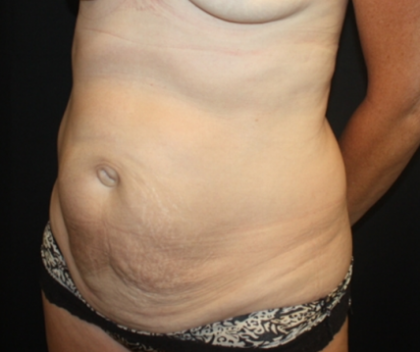 Tummy Tuck Before & After Patient #22258