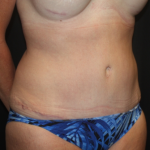 Tummy Tuck Before & After Patient #22258