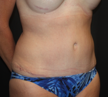 Tummy Tuck Before & After Patient #22258