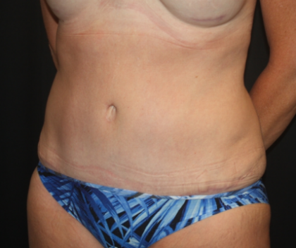 Tummy Tuck Before & After Patient #22258