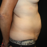 Tummy Tuck Before & After Patient #22258