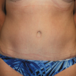 Tummy Tuck Before & After Patient #22258