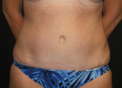 Tummy Tuck Before & After Patient #22258