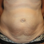 Tummy Tuck Before & After Patient #22258