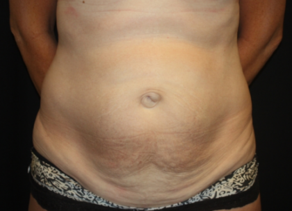 Tummy Tuck Before & After Patient #22258