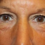 Blepharoplasty Before & After Patient #24858