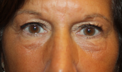 Blepharoplasty Before & After Patient #24858