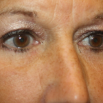 Blepharoplasty Before & After Patient #24858