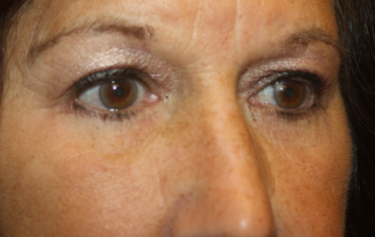 Blepharoplasty Before & After Patient #24858