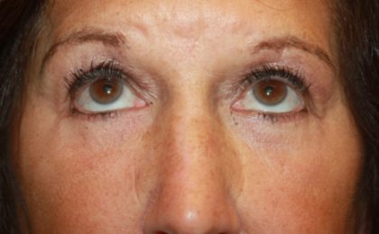 Blepharoplasty Before & After Patient #24858