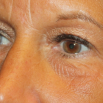 Blepharoplasty Before & After Patient #24858