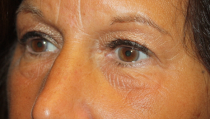 Blepharoplasty Before & After Patient #24858