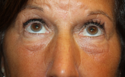 Blepharoplasty Before & After Patient #24858