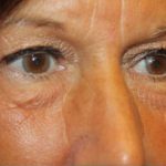 Blepharoplasty Before & After Patient #24858